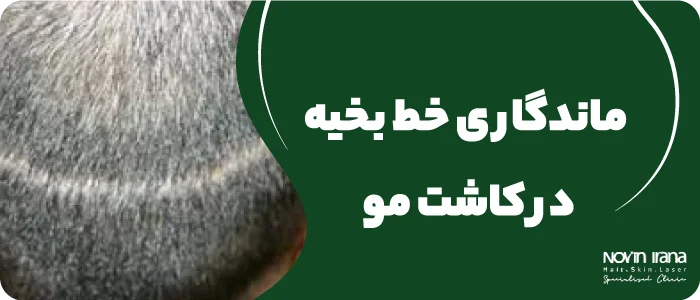 ماندگاری خط بخیه در کاشت مو